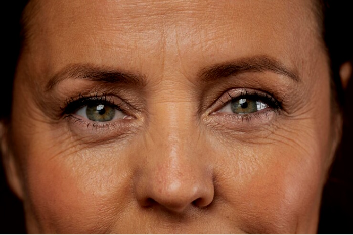 wrinkles due to exposure to the sun and the aging process